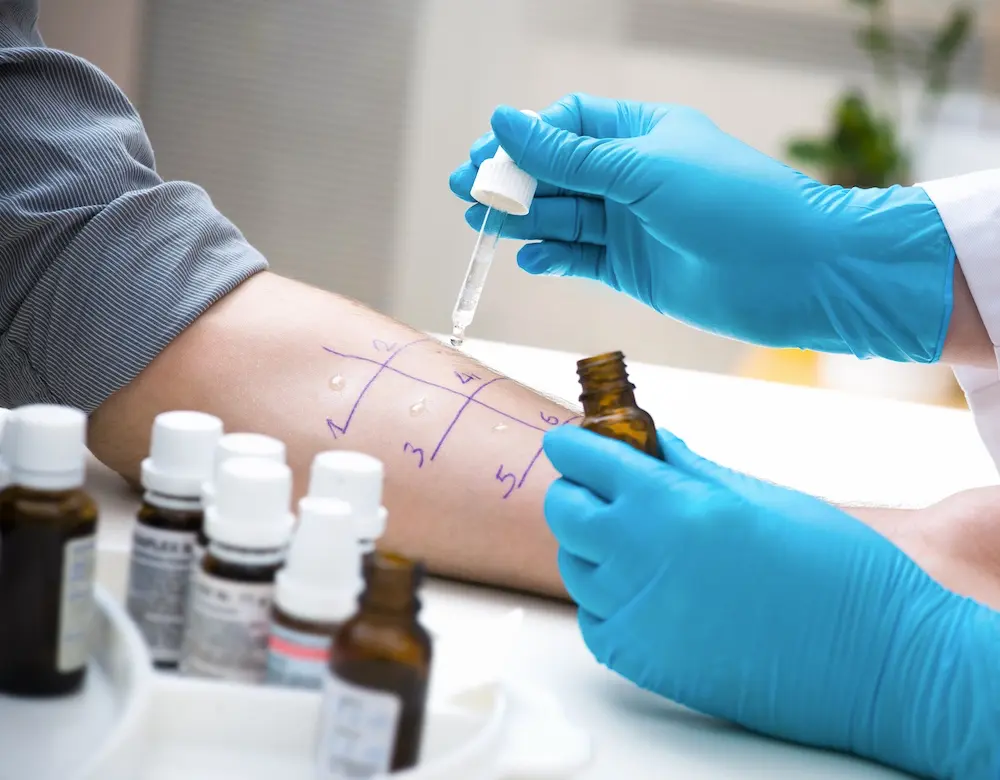 Ein Allergietest wird auf einem Unterarm durchgeführt, weiter zu Allergien