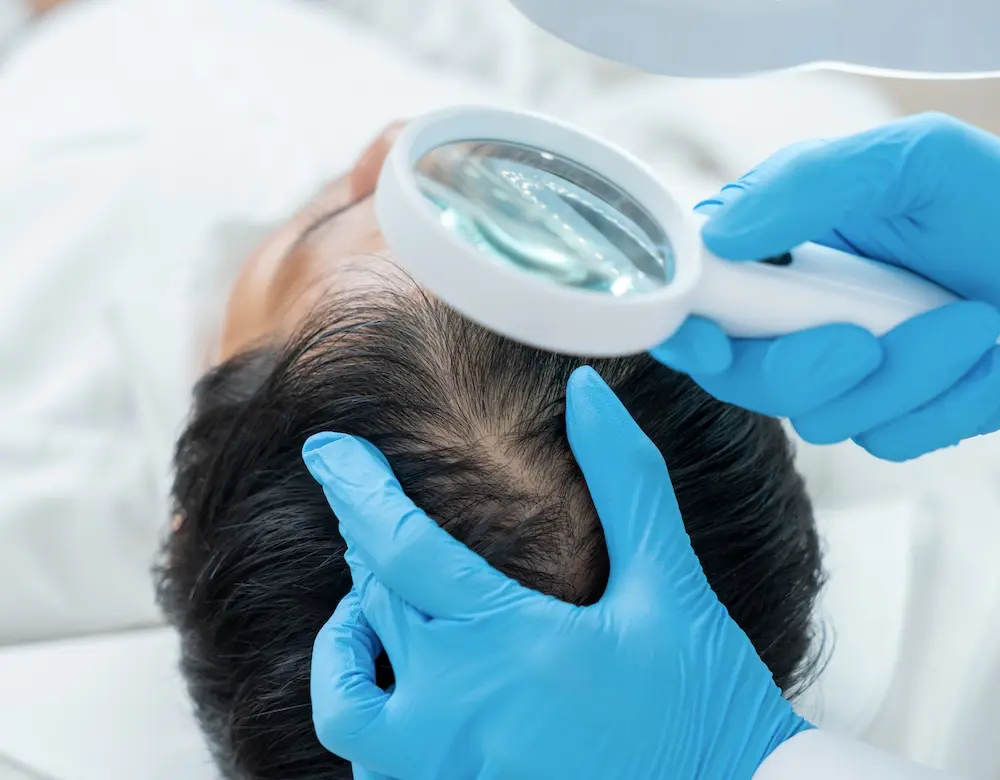 Ein Dermatologe untersucht mit einer Lupe den Haaransatz eines Patienten, weiter zu Haarausfall