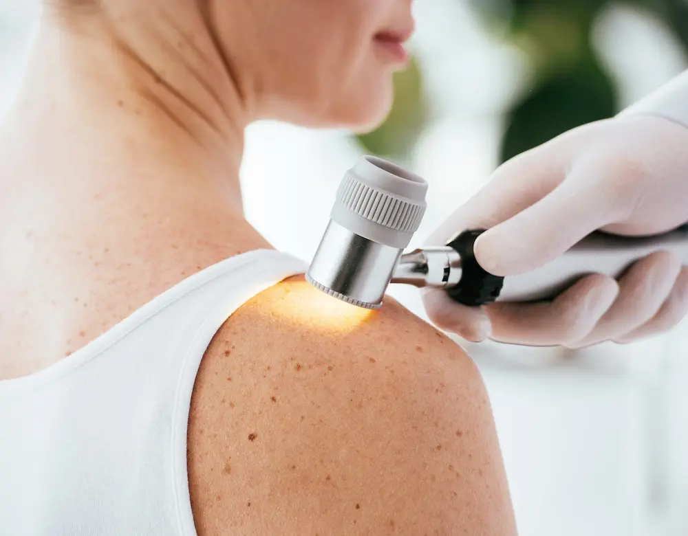 Ein Dermatologe untersucht Leberflecken, weiter zur Hautkrebsvorsorge