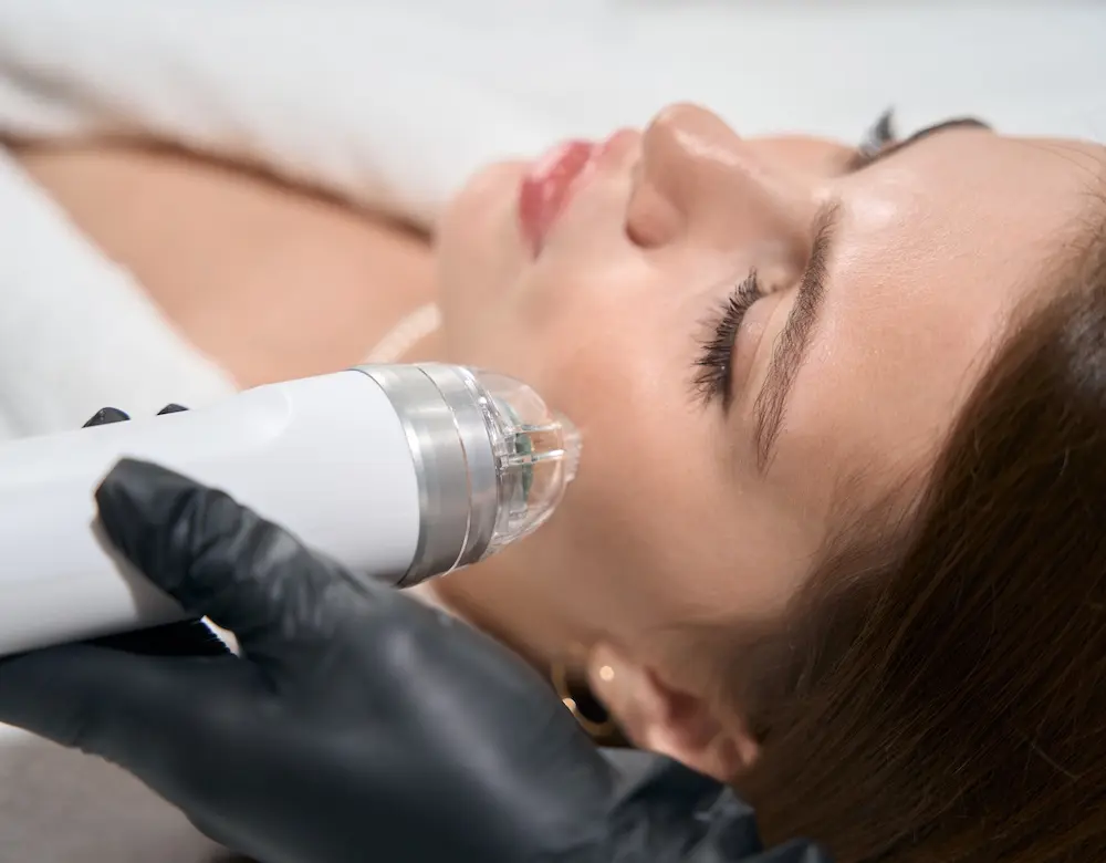 Microneedling Eine Frau bei der Microneedling-Behandlung, weiter zu Microneedling mit PRP